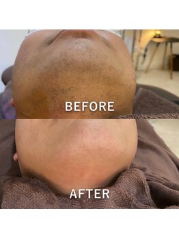 プルーラントエステ キョウト ビジョーラ(PullulantEsthe Kyoto×BEJORA)/髭脱毛