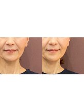 アリュール(Allure)/小顔コルギ30分