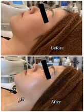 ブランシュール/炭酸カーボキシー×小顔タイト