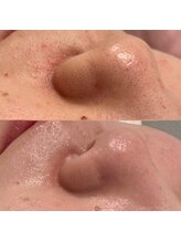 ミューズ(MUSE)/エクストラクション＋白玉ピコ