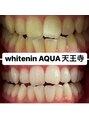 アクア 天王寺店(AQUA)&nbsp;セルフホワイトニング/大阪/天王寺/小顔/ホワイトニング/美白