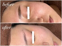 アンドナイン エス店(ANDNINE.)/◆毛穴洗浄+ハーブピーリング1回