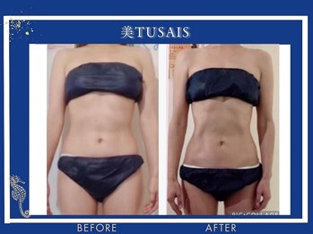 ビテュセ(美Tu sais)/【痩身・ダイエット】ボディケア