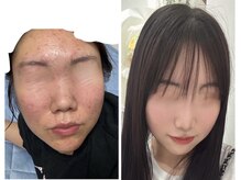 パルティール 恵比寿店(partir)/赤ニキビも諦めないで！