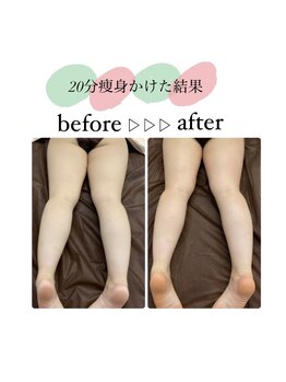 そらまめ/ラジオ波20分かけた写真です