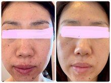 ヒメミ(Himemi)/BBL光エステ6回目照射後のお写真