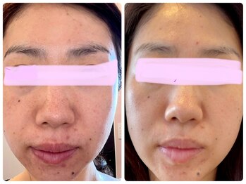 ヒメミ(Himemi)/BBL光エステ6回目照射後のお写真