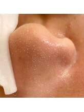 ラナ(Lana)/3D毛穴洗浄（吸引前写真）