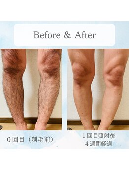 モモナ(Momona)/佐世保/脱毛/脚脱毛/足脱毛