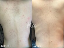 キー(kii)/背中ニキビケア