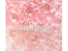 ミニョスキンラボ/韓国式ハーブピーリング6回