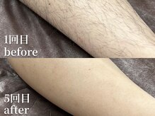 ボス 名古屋店(BOSS)/【腕脱毛　before & after】