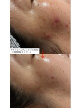 トモニ(TOMONI)/ダクトピールフェイシャル2回目