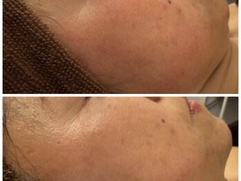 イディアル(IDE'AL)/陶肌トリートメント＋生酵素