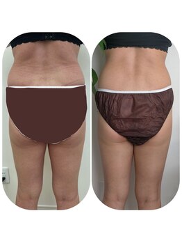 エクシア(EXCIA)/Before&After 3