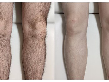 エムスリー(m3)/脚脱毛