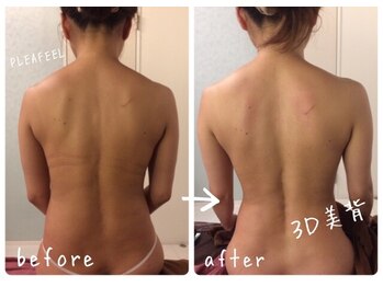 プレフィール(PLEAFEEL)/バストケア◇症例◇たまプラーザ