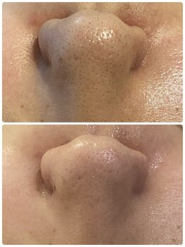 エヌ(enu)/毛穴洗浄/フェイシャル