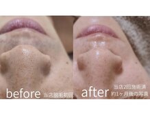 カヌヌ(kanunu)/毛穴洗浄/ハーブピーリング