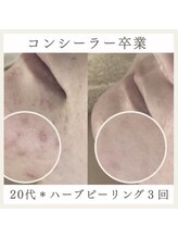 サロンドペシェ(salon de peche)/20代＊ハーブピーリング３回