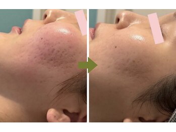 リボンサロン(Ri.bon Salon)の写真/【水光肌管理】剥離なし◆幹細胞配合ハーブピーリング＊ハリ艶アップ☆本格フェイシャルで肌質改善☆