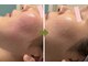 リボンサロン(Ri.bon Salon)の写真/【水光肌管理】剥離なし◆幹細胞配合ハーブピーリング＊ハリ艶アップ☆本格フェイシャルで肌質改善☆