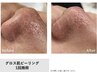 黒ずみ毛穴ケア☆【お試し・鼻のみ　3/31まで☆　￥4.000→￥１,900