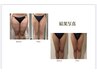 【5月キャンペーン】モニター限定　脂肪燃焼剤10ミリ¥44,000→¥12,000