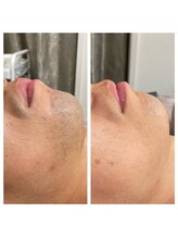 ハピネスビューティーサロン(happiness beauty salon)/脱毛/メンズ/レディース/おヒゲ