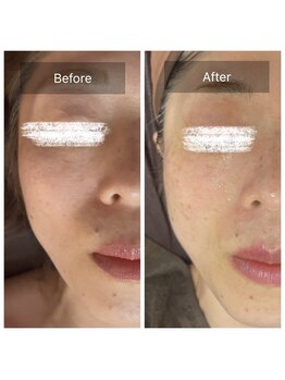 ラビ(RABBI)/40代女性　小顔矯正