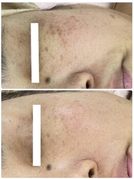 パルティール(Partir)/ハーブピーリング♪