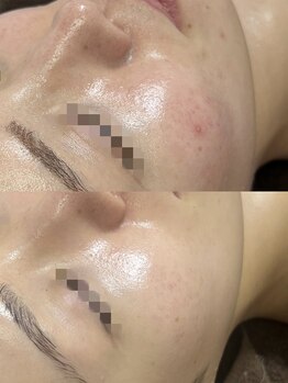 レイ(Lei)/ニキビ/毛穴/ハーブピーリング