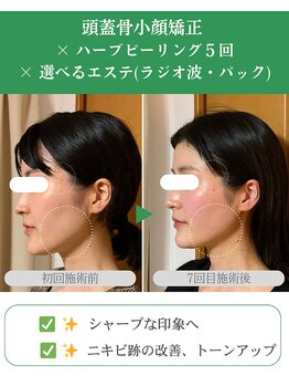 ブプラ 代々木上原店(BUPURA)/ハーブピーリング×肌荒れ改善