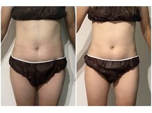 OBS/お腹集中ダイエット