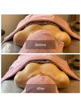 リンドール(RinDoll)/ダイエット/痩身/耳つぼ