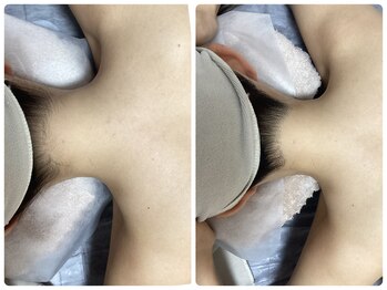 ルルトウキョウ 池袋店(LULU.tokyo)/うなじ脱毛