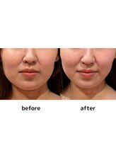 シエル(Ciel)/フェイスラインがすっきり！