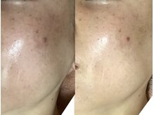 サロン ド グレイシャス エステティック(Salon de GRACIOUS esthetic)/シミケア