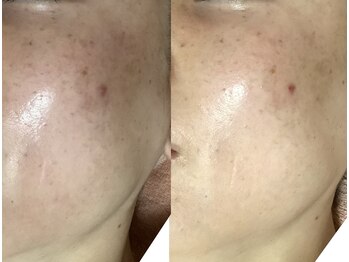 サロン ド グレイシャス エステティック(Salon de GRACIOUS esthetic)/シミケア