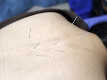 ゆに鍼灸 整体院/体の鍼施術