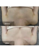 サロンツキ(salon tuki)/【バストアップ】症例★