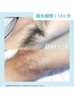 メンズクリア 草津店/【メンズクリア】お客様の施術例