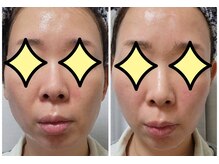 シンシア(sincere)/サーマクール/リフトアップ/小顔