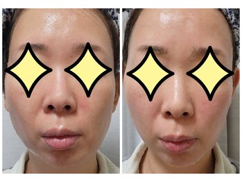 シンシア(sincere)/サーマクール/リフトアップ/小顔