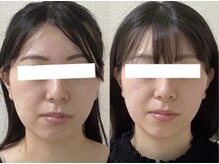 エミルカ 仙台(EMILUCA)/美姿勢＆美顔筋リフト