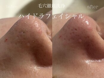 キアラ(CHIARA)/ハイドラフェイシャル