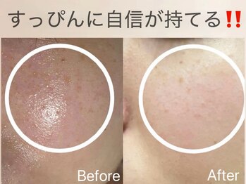 ルンルン(run run)/1回だけでも薄くなります