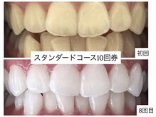 ホワイトニングショップ 明石大久保店/【BeforeAfter】10回券のお客様