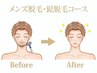 【男性首上コース★】(おヒゲ+襟足)ヒアルロン酸美肌脱毛