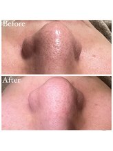 マドモアゼル 麻布十番/毛穴洗浄